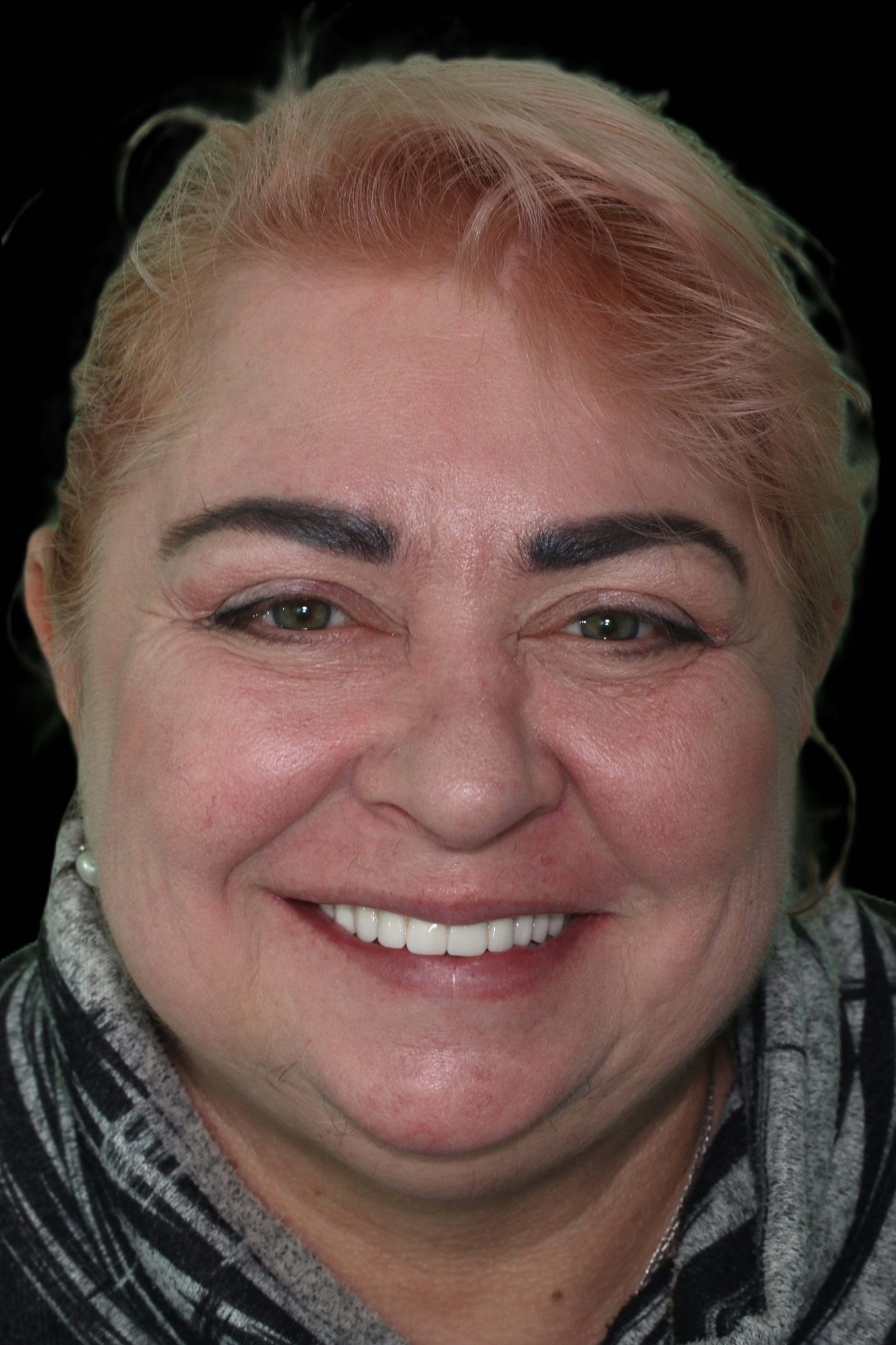 Zubni-implantaty-po-havirov Zubni-implantaty-po-havirov