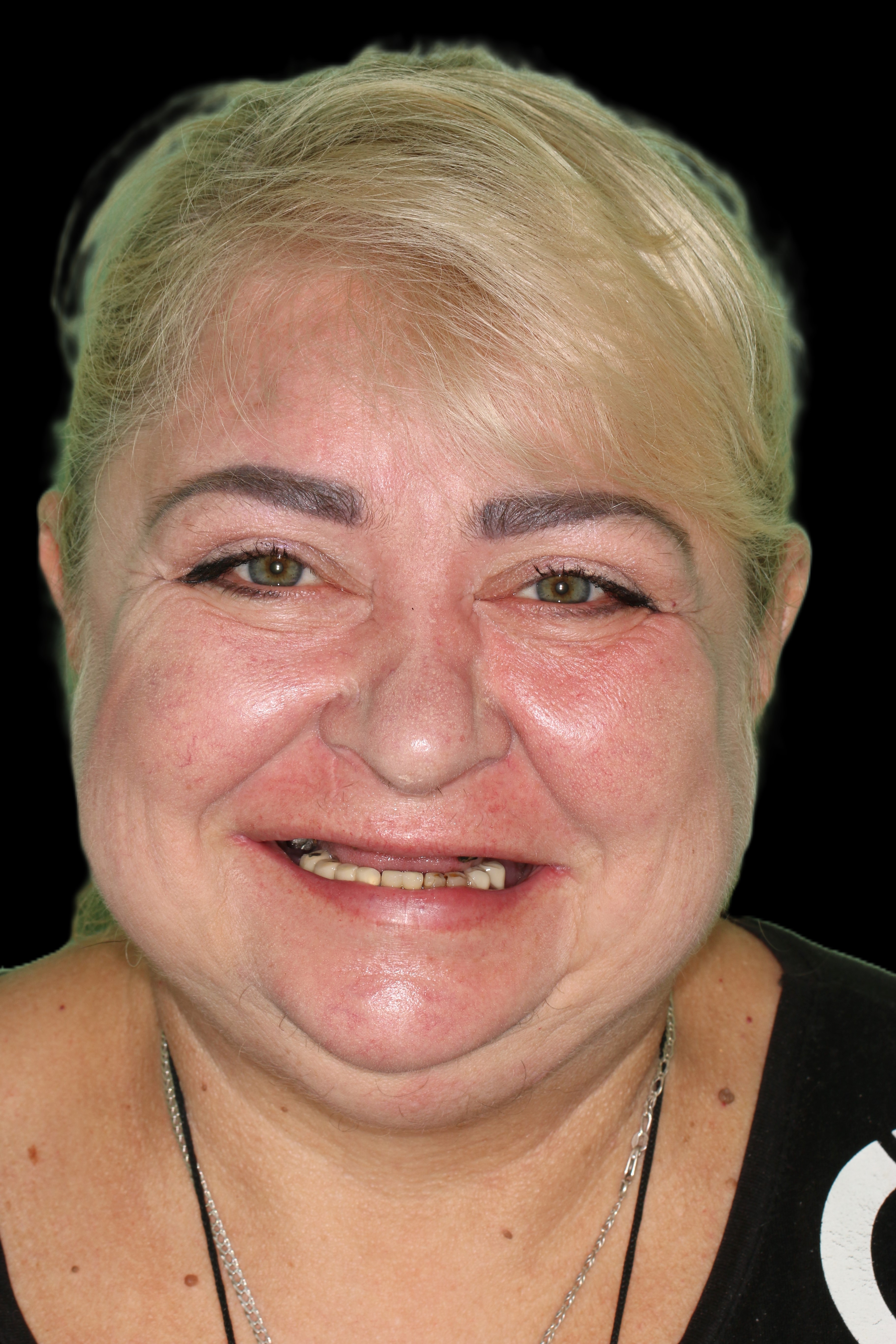 Zubni-implantaty-pred-havirov Zubni-implantaty-pred-havirov